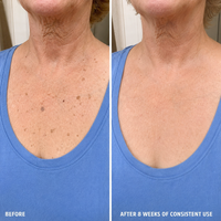 SK Renewal 40 — Advanced Keratolytic Cream For Rough, Raised Seborrheic Keratoses